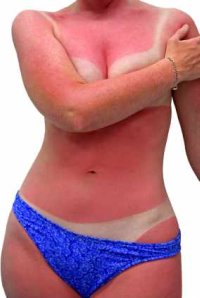 sunburned woman